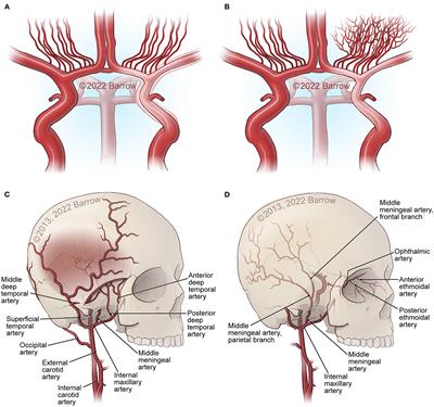 Physiological and pathophysiological mechanisms of the molecular and cellular biology of angiogenesis and inflammation in moyamoya angiopathy and related vascular diseases